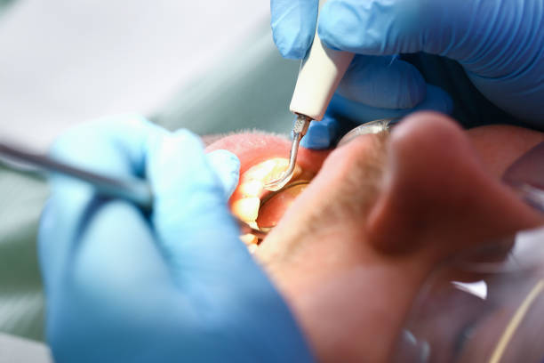 Best Emergency Dental Care for Broken or Chipped Teeth in Sterling, VA